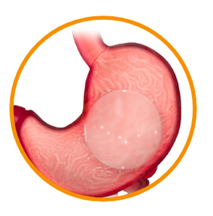 Ballon gastrique Orbera pour perdre du poids sans chirurgie