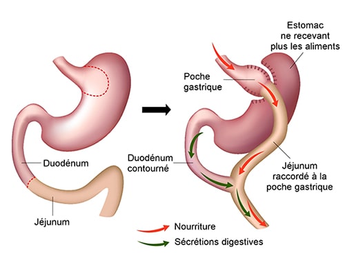 Technique du bypass gastrique. Chirurgie obésité près d'Aix-en ...