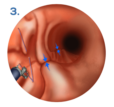 Suture pour que la paroi gastrique se replie comme un accordéon